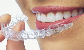 PureNZDental-clear-aligners