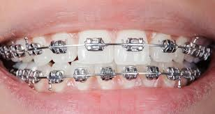 PureNZDental-traditional-metal-braces